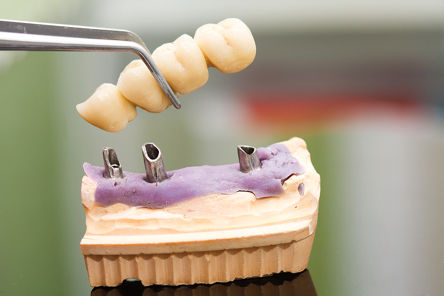 What Are Mini Implant Dentures?
