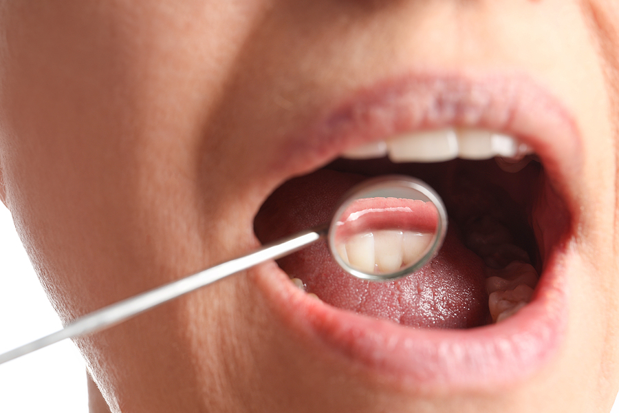 What is Included in a Teeth Cleaning Session?