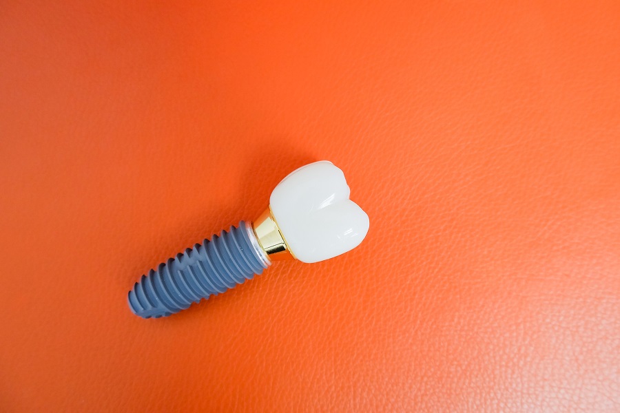 Getting An Implant Restoration
